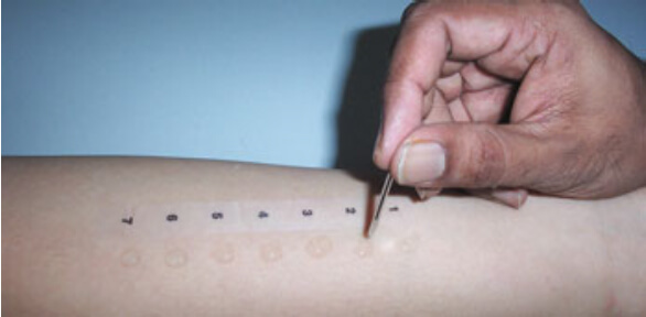 Skin prick test