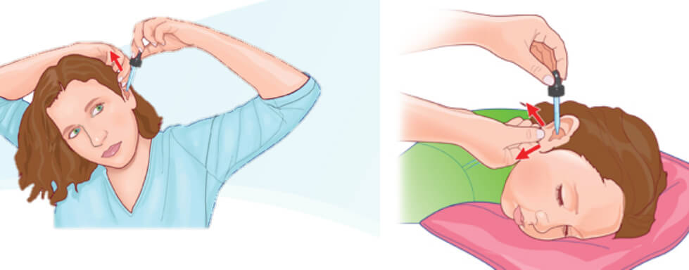 Diagram showing how to hold your ear to put in eardrops