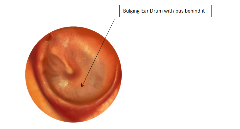 normal tympanic membrane vs bulging