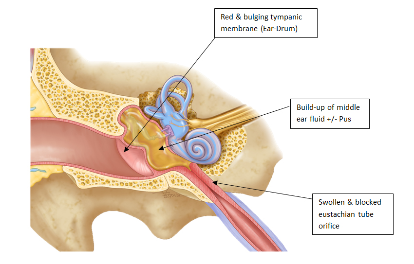 Ventilation tubes (grommets) for otitis media with effusion (OME