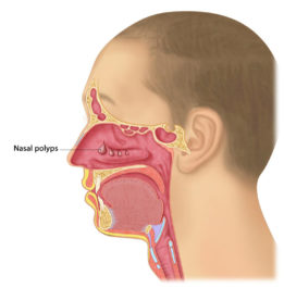 Chronic Rhinosinusitis, Nasal Polyps - Melbourne ENT Group