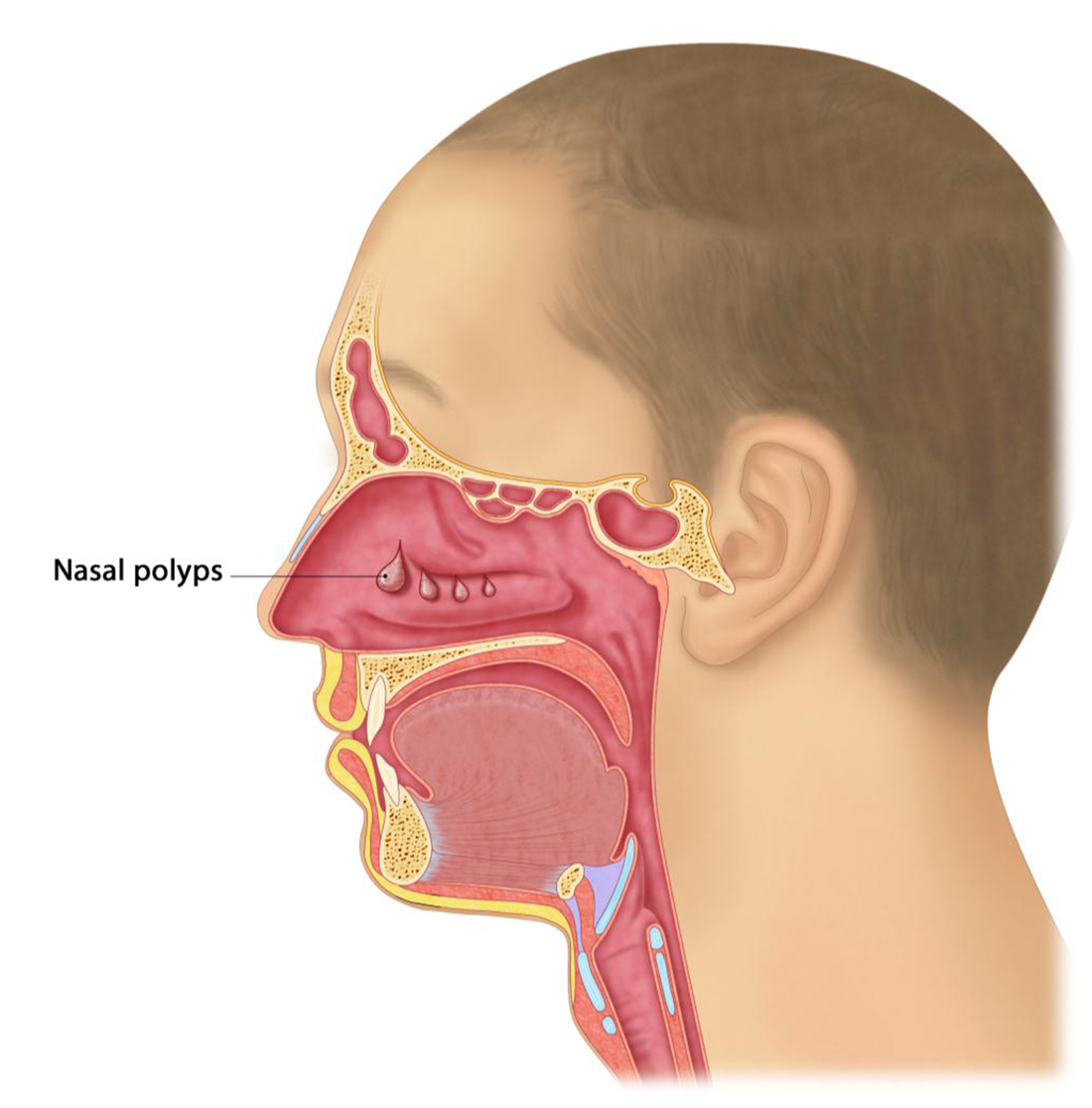 nasal polyps blocked nose